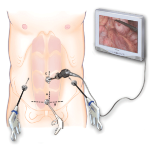 Bariatric Surgery Instruments
