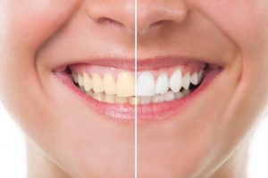 Teeth Whitening Procedure